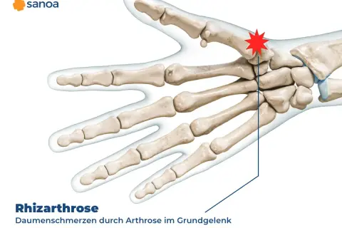 Skelett des Daumens mit rotem Stern am Grundgelenk, der Rhizarthrose und Daumenschmerzen anzeigt.