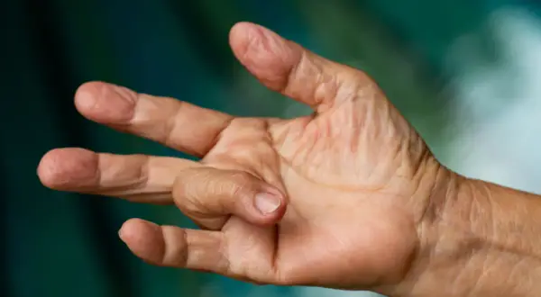 Nahaufnahme einer Hand, bei der ein Finger in einer gekrümmten Position verharrt. Dies kann ein Symptom für einen Schnappfinger sein, dessen Ursache oft eine Entzündung der Sehnenscheide ist.