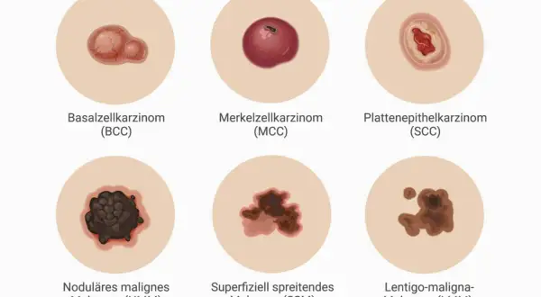 Sechs Darstellungen verschiedener Hautveränderungen, darunter verschiedene Formen von dunklem Hautkrebs wie Melanome und Karzinome.
