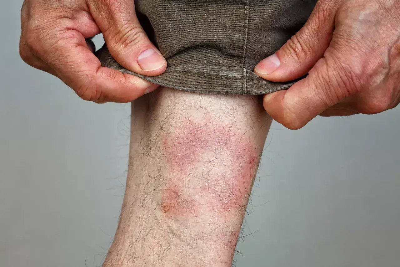 Rote, gereizte Haut am Bein, die auf einen Zeckenbiss hindeutet. Hände ziehen die Hose hoch.
