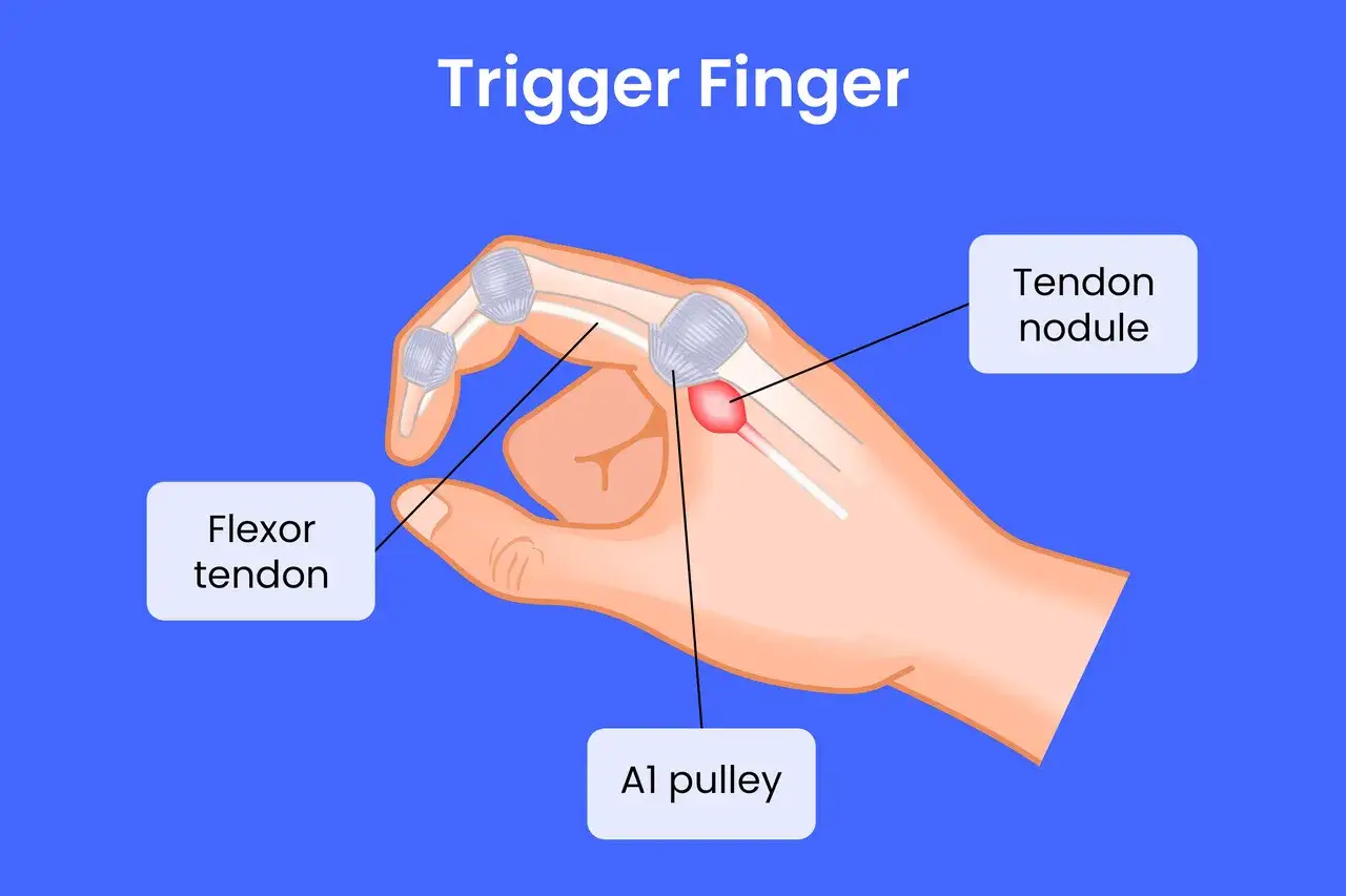 Illustration zeigt, wie ein Sehnenknoten den Flexorsehnen-Gleitweg behindert, was zu Schmerzen beim Beugen des Fingers f&uuml;hrt.