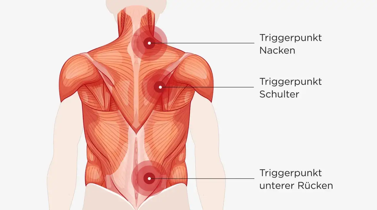 R&uuml;ckenansicht der Muskulatur mit Hervorhebung von Triggerpunkten im Nacken, an der Schulter und im unteren R&uuml;cken, die auf paravertebrale Muskelverspannung hindeuten.