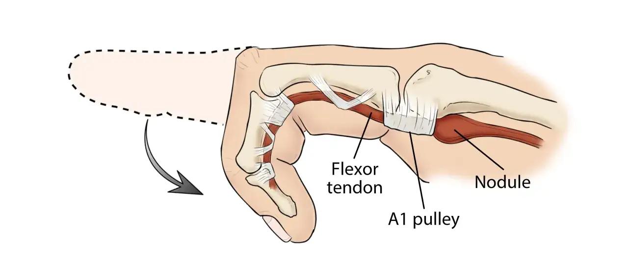 Illustration zeigt einen verdickten Flexorsehnen-Knoten, der die A1-Sehnenrolle blockiert. Dies erklärt, wie man einen Schnappfinger behandeln kann.