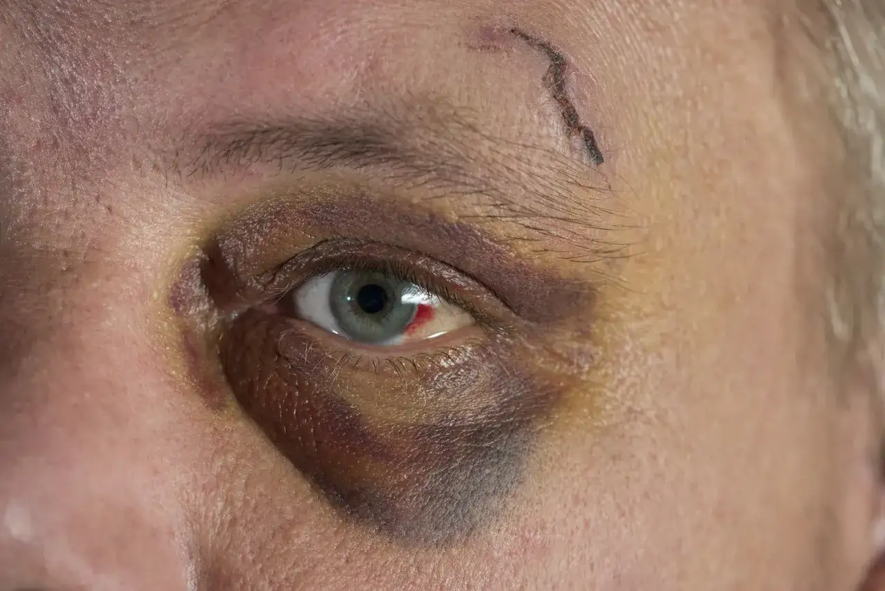 Ein blaues Auge mit einer Sch&uuml;rfwunde auf der Stirn. Die Verf&auml;rbung um das Auge deutet auf eine Verletzung hin, die zeigt, wie lange ein blaues Auge bleibt.