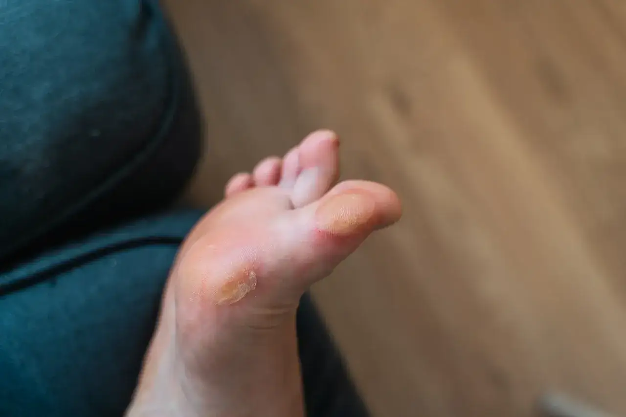 Fu&szlig;sohle mit deutlicher Druckstelle am Zeh, die auf Reibung durch Schuhe hinweist.