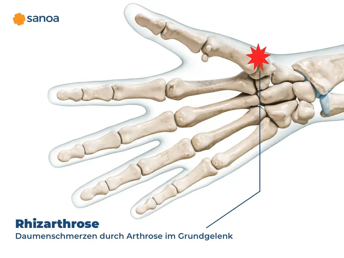 Skelett der Hand mit hervorgehobenem Daumengrundgelenk, das auf Schmerzen im Daumengelenk durch Rhizarthrose hinweist.