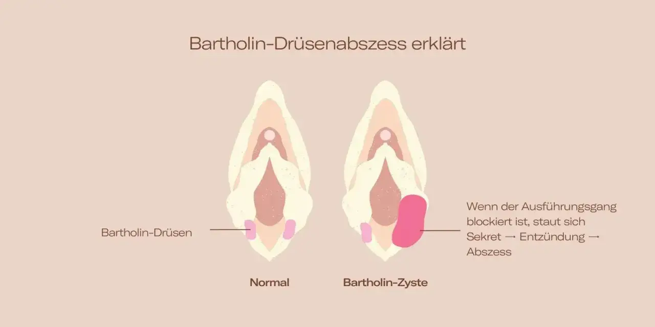 Vergleich von normaler Bartholin-Dr&uuml;se und Bartholin-Zyste/Abszess im Intimbereich. Bei Blockade staut sich Sekret, was zu Entz&uuml;ndung und Abszess f&uuml;hrt.