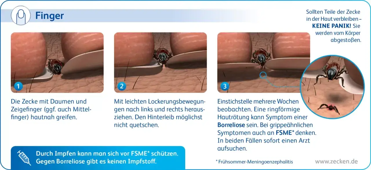 Zeckenbiss-Entfernung: Zecke greifen, locker herausziehen, Stichstelle beobachten. Bei R&ouml;tung Borreliose, bei grippalen Symptomen FSME m&ouml;glich.
