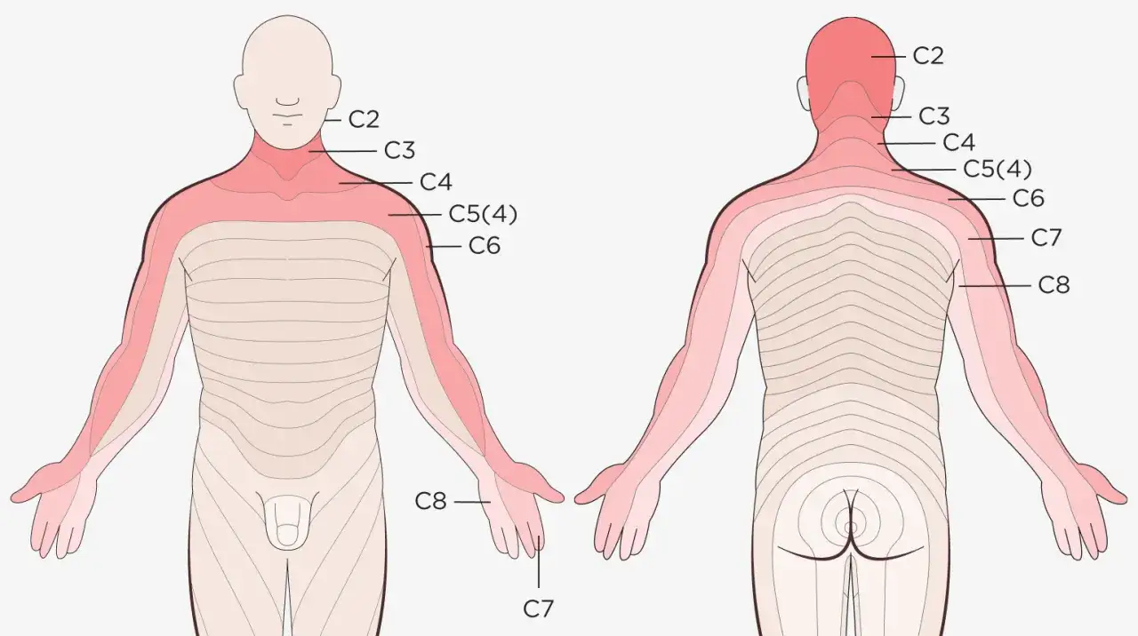 Schmerzareale bei histaminbedingter Nackenverspannung, von C2 bis C8 reichend.